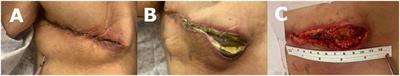 Management of irradiated post-mastectomy wound dehiscence with synthetic electrospun fiber matrix: a case report
